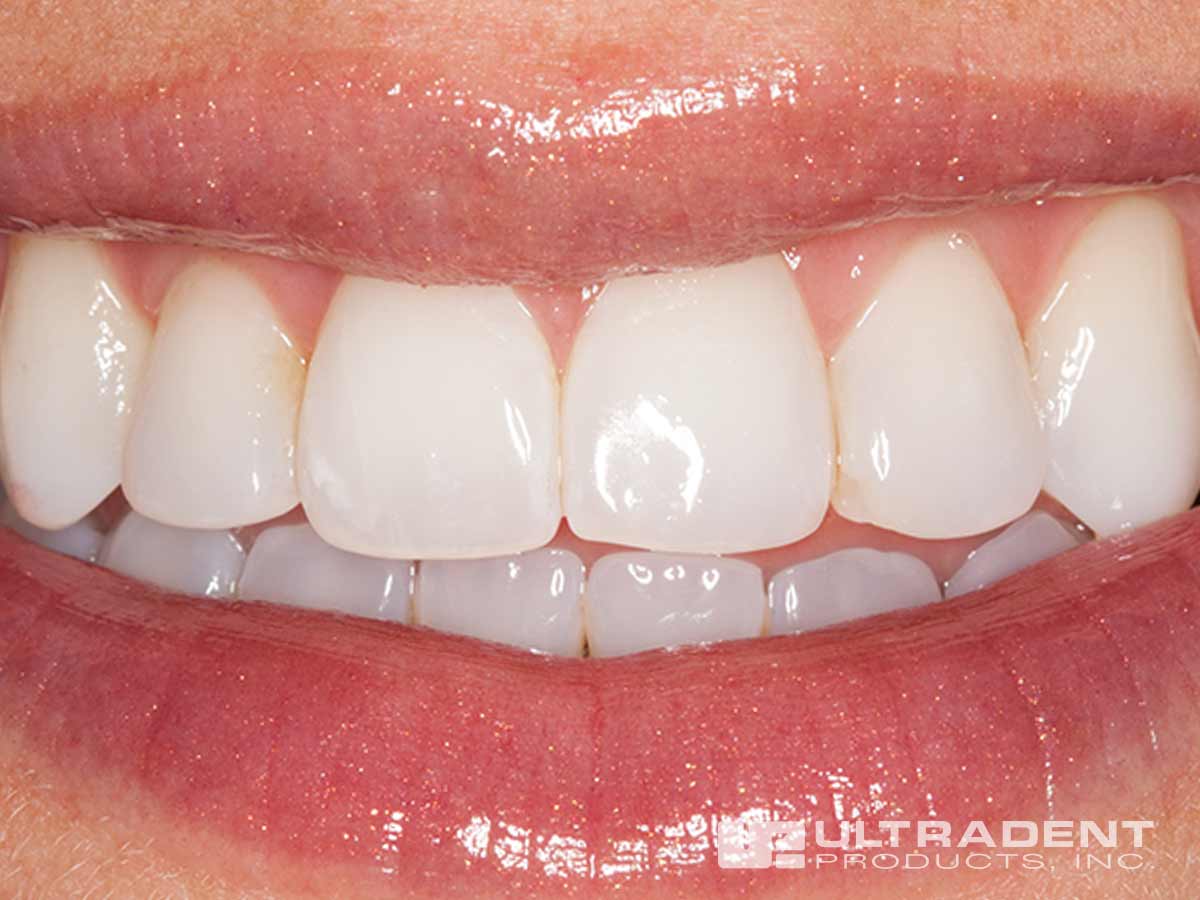 Benefits That Last Enamelast™ Fluoride Varnish